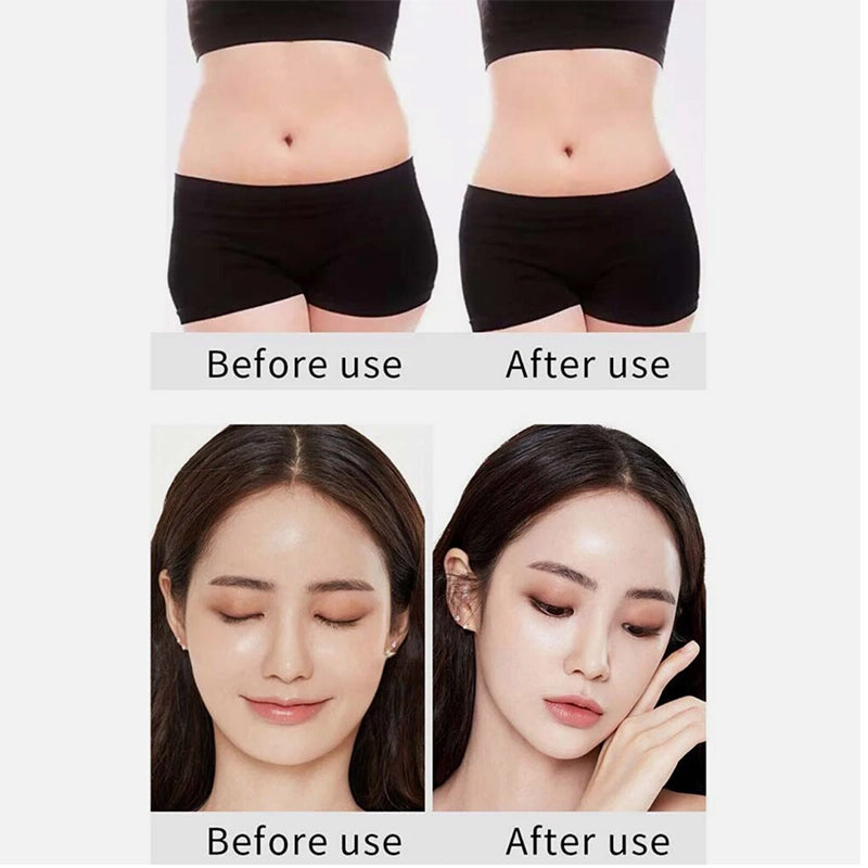 6-in-1 Ultrasonic Cavitation + RF Machine BioHealing®